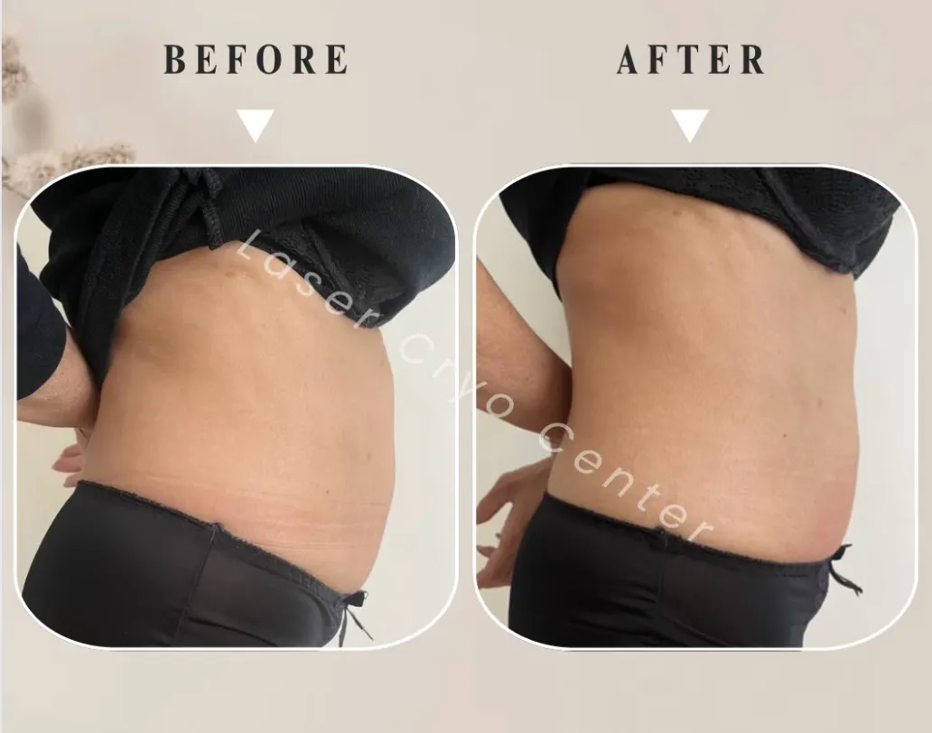 Résultat cryolipolyse avant et après - 1